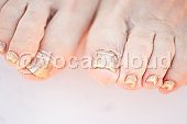fungal infection Image